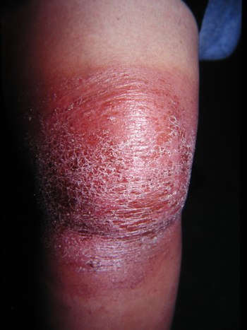 Контактный дерматит на ноге